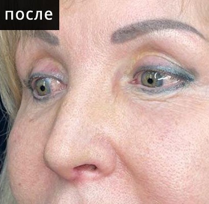 После ринопластики, три четверти, кейс 4