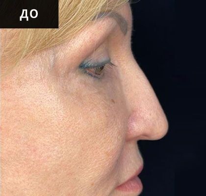До ринопластики, профиль, кейс 5